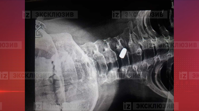Рентгеновский снимок, который сделали пострадавшему мальчику