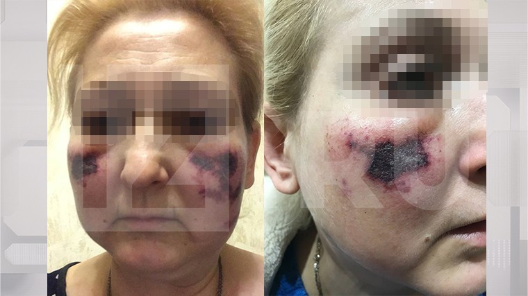 Петербурженка пострадала из-за действий косметолога