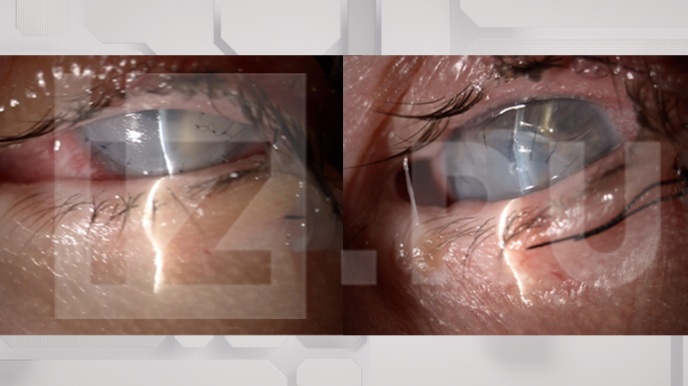 После пластической операции оба глаза 46-летней Инны потеряли способность видеть