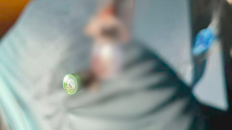 Врачи Мытищинской больницы извлекли стоматологический инструмент из&nbsp;бронха пациента