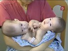 В Шанхае провели рекордную по срокам операцию по разделению сиамских близнецов