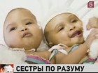 Британские хирурги смогли разделить сиамских близнецов, сросшихся головами