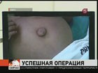 В Перу успешно завершили операцию по разделению двух близнецов