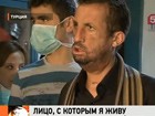 В Турции впервые на публике появился первый пациент, которому была сделана операция по пересадке лица