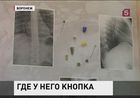 В Воронеже хирурги достали из легких подростка канцелярскую кнопку