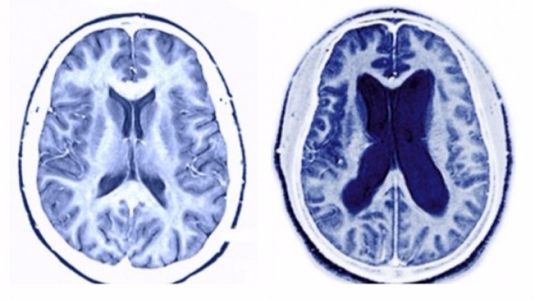 Ученые: аспирин может защитить от болезни Альцгеймера