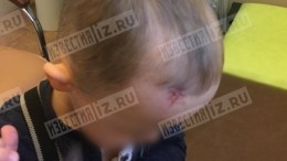 У ребенка, к которому не пустили скорую в детсад в Петербурге, останется шрам