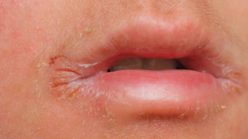 От инфекций до язвы: сухие губы назвали признаком серьезных заболеваний