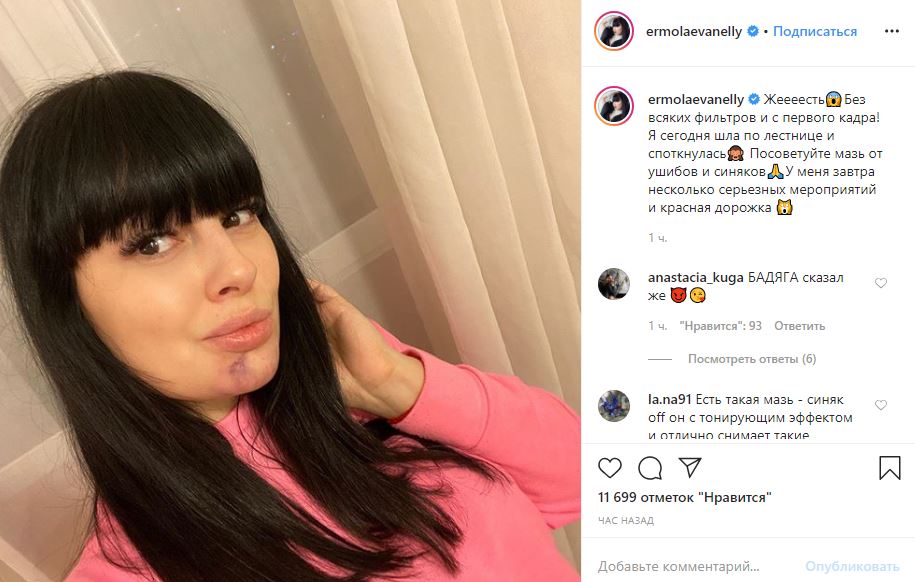 Звезда «Дома-2» Нелли Ермолаева травмировала лицо после падения с лестницы