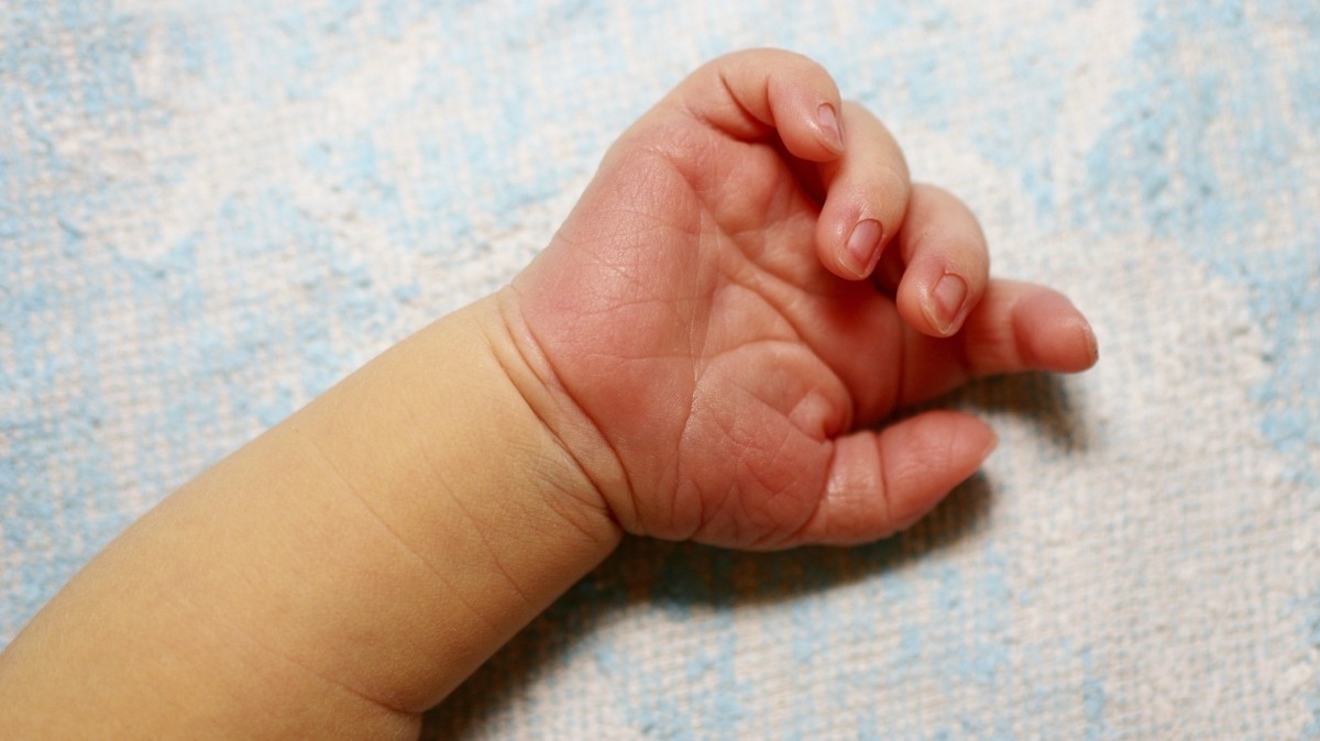 Рождение детей без пальцев