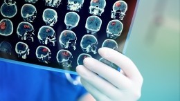 Какие безобидные симптомы могут говорить о раке мозга