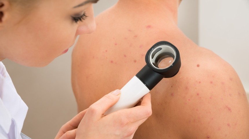 Онкологи рассказали о семи неочевидных признаках рака кожи