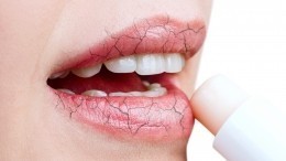 Почему появляются трещинки в уголках губ и о каких болезнях они говорят