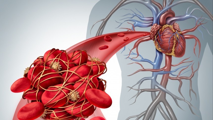 Прямой путь к тромбозам: врач рассказал, какую болезнь нельзя игнорировать