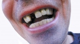 Стресс попутал: стоматолог назвала причины выпадения зубов