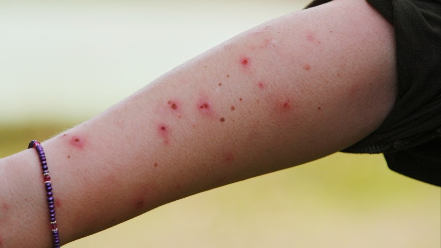 Дачные угрозы: насколько опасны укусы комаров, ос, слепней, змей?