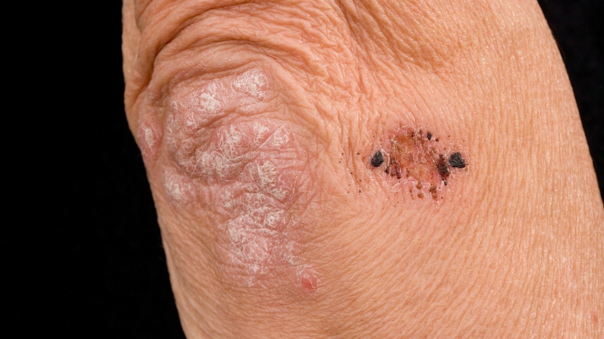 Шелушение кожи - причины появления ксероза кожи | Симптомы, диагностика и способы лечения