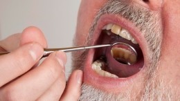 Зубы после ковида: как переболевшим следить за гигиеной полости рта