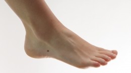 Ноги не носят: врачи назвали страшные последствия плоскостопия