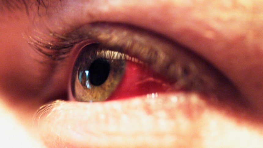 Красные сосуды на белках глаз: причины появления и методы лечения