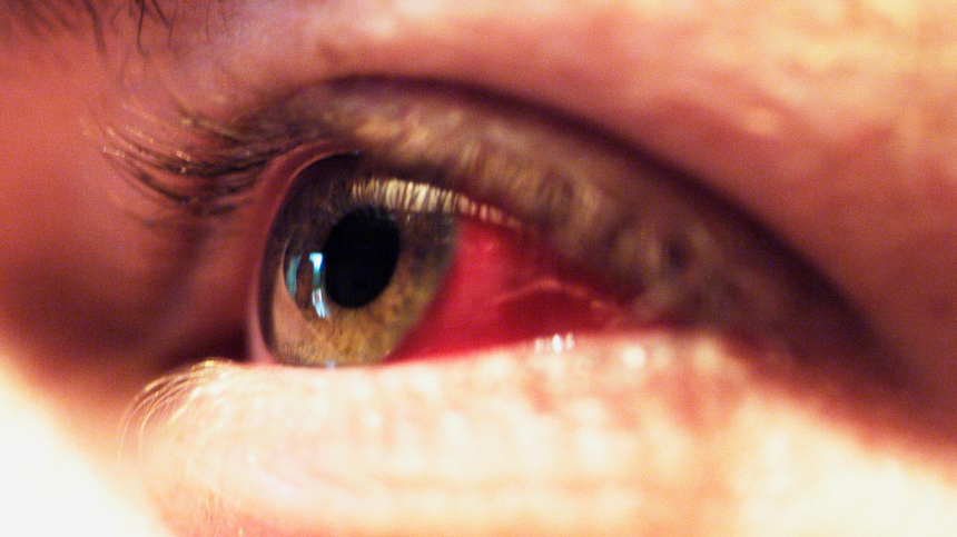 Кондиционер может привести к конъюнктивиту: клещи попадают в глаза
