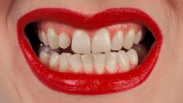 Щель между зубов: о каких проблемах со здоровьем говорят «просветы»