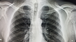 Потливость и потеря веса: как отличить туберкулез от ОРВИ