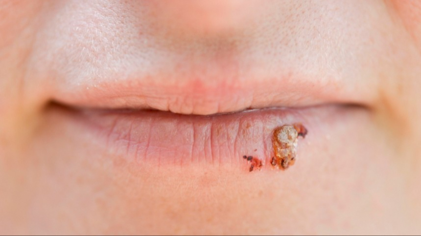 Как лечить герпес на губах и насколько он заразен | Пятый канал - новости и видео | Дзен