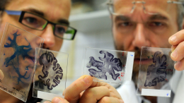 Победа в тяжелой борьбе: ученые выявили ранний признак болезни Альцгеймера