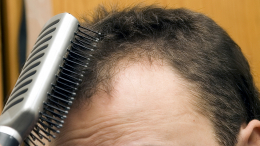 Трихолог перечислила основные причины выпадения волос