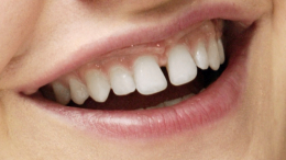 Щель между зубов: о каких проблемах со здоровьем говорят «просветы»