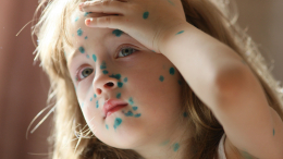 «Ветряночные вечеринки»: что это такое и в чем их опасность