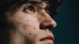 Несбыточная мечта или реальность? Как лечить акне в зрелом возрасте