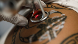 На всю жизнь: все о способах удаления татуировок