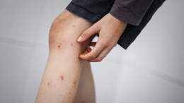 «Вирус массово распространен»: как защититься от лихорадки чикунгунья