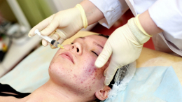 «Нужно обследование»: когда при акне и выпадении волос пора идти к врачу