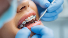 Гляжу в тебя, как в зеркало: как неправильный прикус влияет на красоту женщины