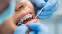 Гляжу в тебя, как в зеркало: как неправильный прикус влияет на красоту женщины