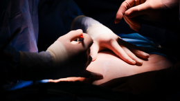 Синдром Рапунцель: из желудка 17-летней девушки вырезали гигантский ком волос