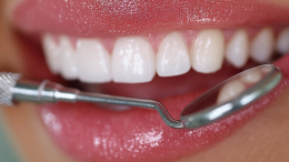 Почему отбеливание зубов энзимной пастой может быть опасно — мнение стоматолога