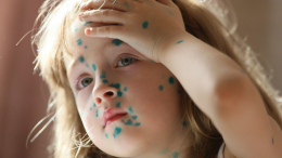 В России стремительно растет заболеваемость ветрянкой