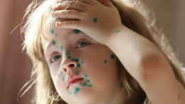 Зарази меня полностью: зачем родители устраивают «ветряночные вечеринки» для детей