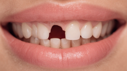 Сон о выпадающих зубах: что подсознание пытается вам сказать