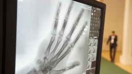 «Главный враг костей»: какие продукты вредны для скелета