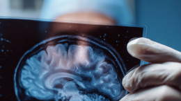 Мутация генов: обнаружено новое заболевание мозга