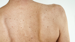 Печать ангела-хранителя: как использовать силу родинок и узнать по ним судьбу