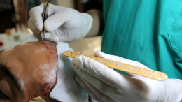 Турист умер в Стамбуле после пересадки волос и стоматологического лечения