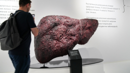 Тревожная динамика: врач предупредила о «буме» цирроза печени в России