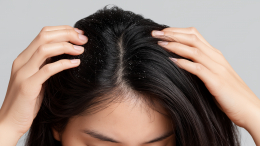 Голова вся в хлопьях: врач рассказала о причинах появления перхоти