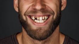 Стоматолог назвала меры экстренной самопомощи при выбитом зубе